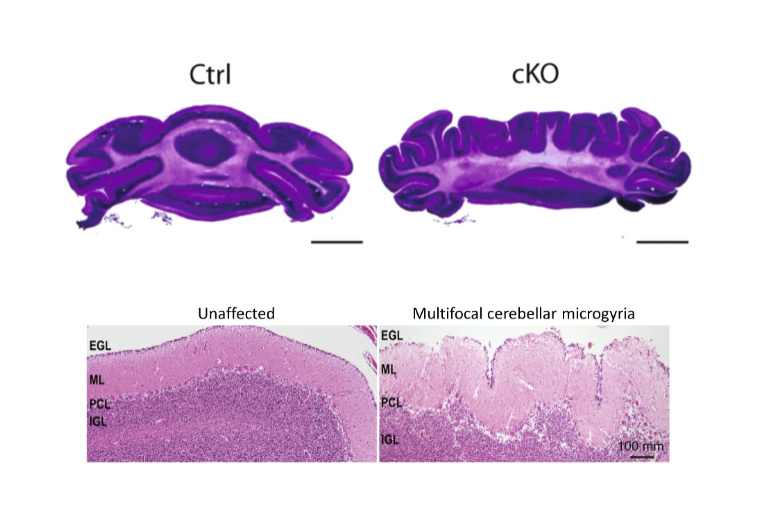 The upper right panel illustrates abnormal folds that appear in the mouse cerebellum due to a loss of CHD7, compared to a control mouse (upper left). Lower panels show unaffected tissue (left) and aberrant folding in the cerebellum (right) in a patient with CHARGE syndrome.