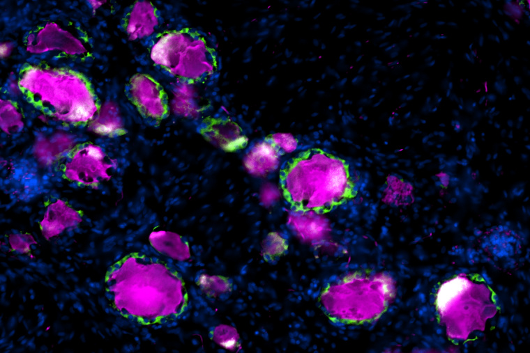 Human dorsal root ganglion stained for the neuronal marker TUJ1 (magenta) surrounded by satellite glial cells stained with FASN (green).