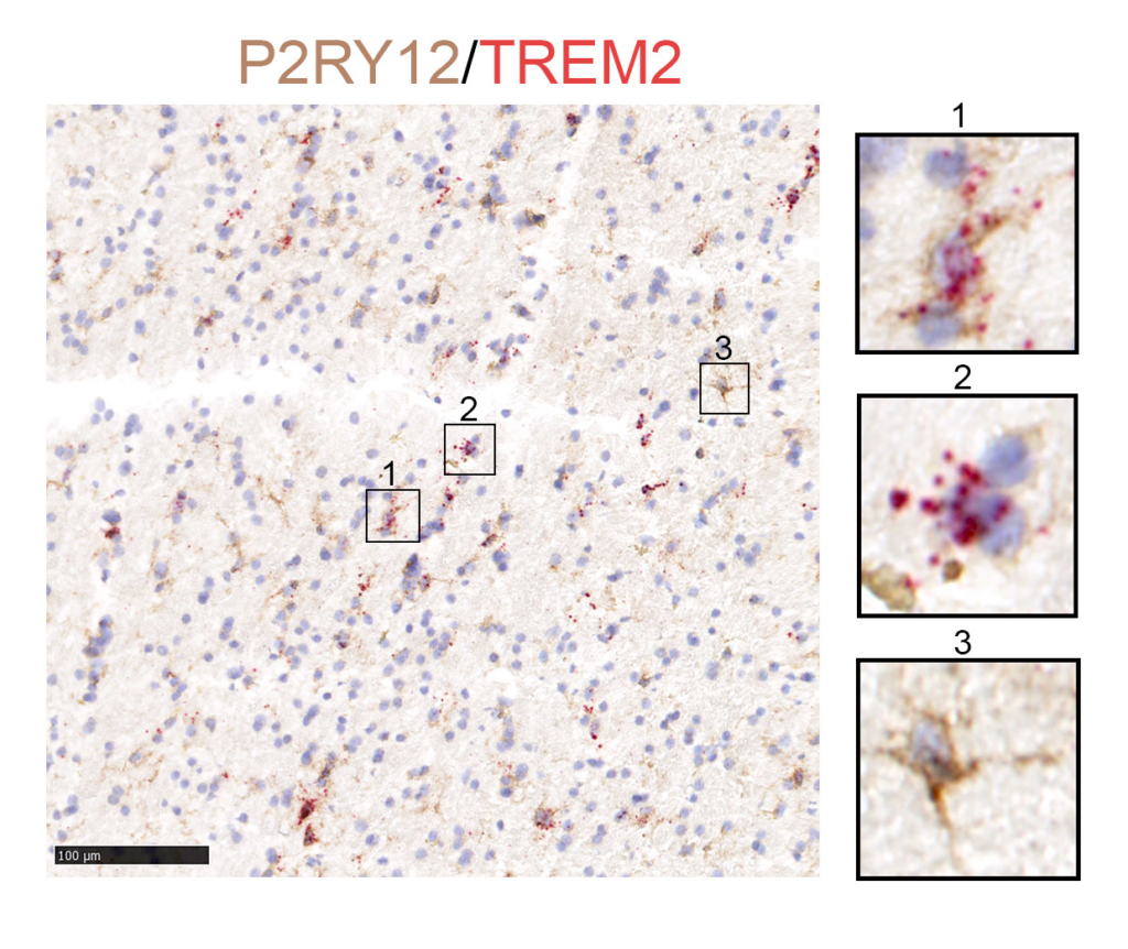 Immunohistochemistry staining of activated microglia in putamen of an individual with AD (microglia labeled by marker protein P2RY12, brown, and activation indicated by TREM2 transcripts, red)