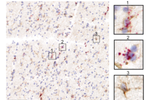 mmunohistochemistry staining of activated microglia in putamen of an individual with AD (microglia labeled by marker protein P2RY12, brown, and activation indicated by TREM2 transcripts, red)