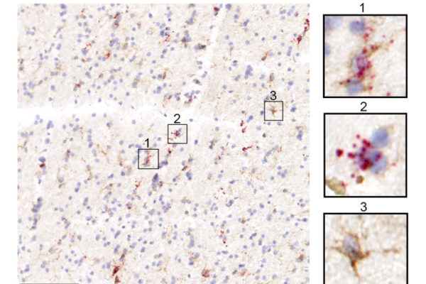 Transcriptomic changes in glia linked to specific neurodegenerative diseases